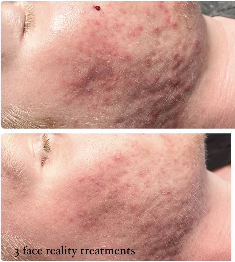 acne Hyperpigmentation results