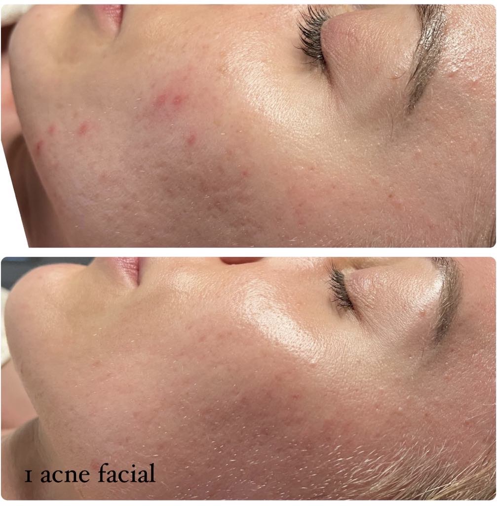 acne Hyperpigmentation results