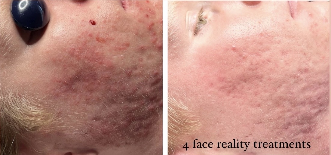 acne Hyperpigmentation results