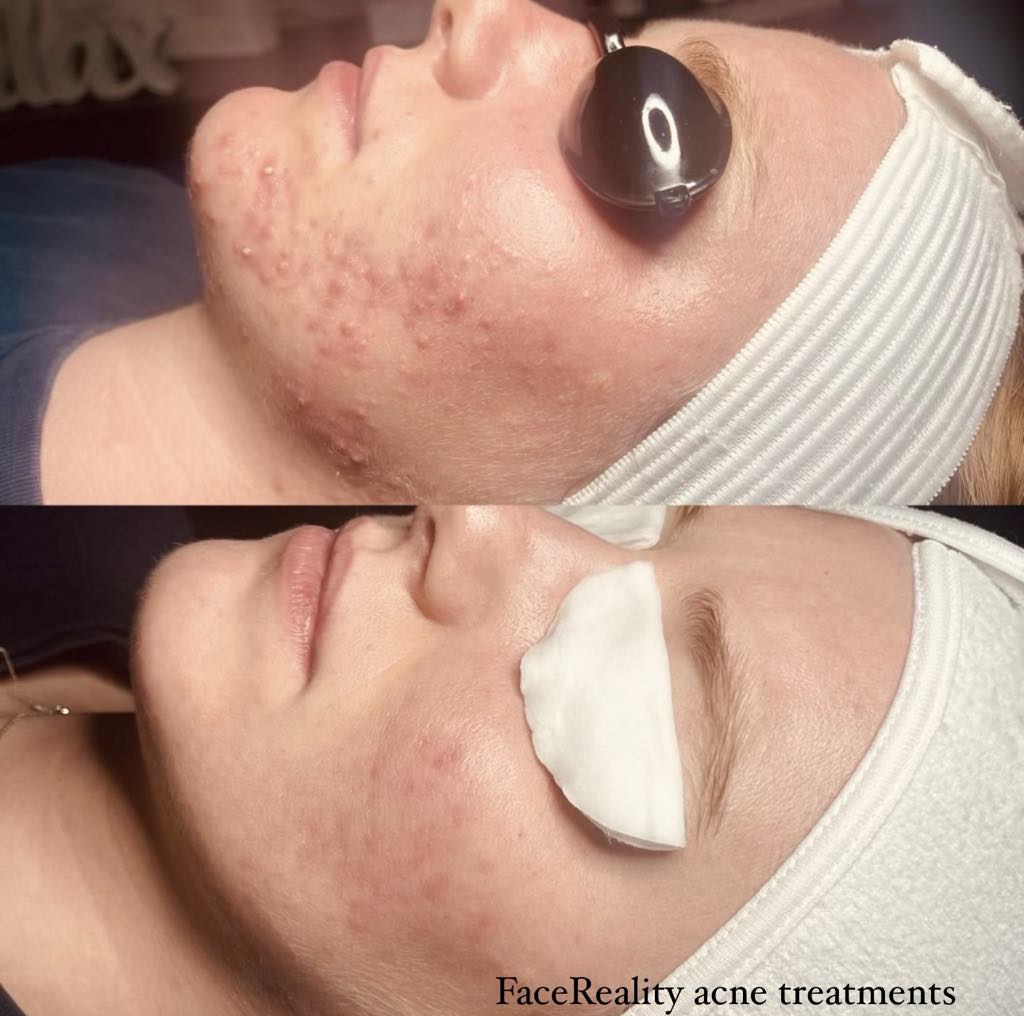 acne Hyperpigmentation results