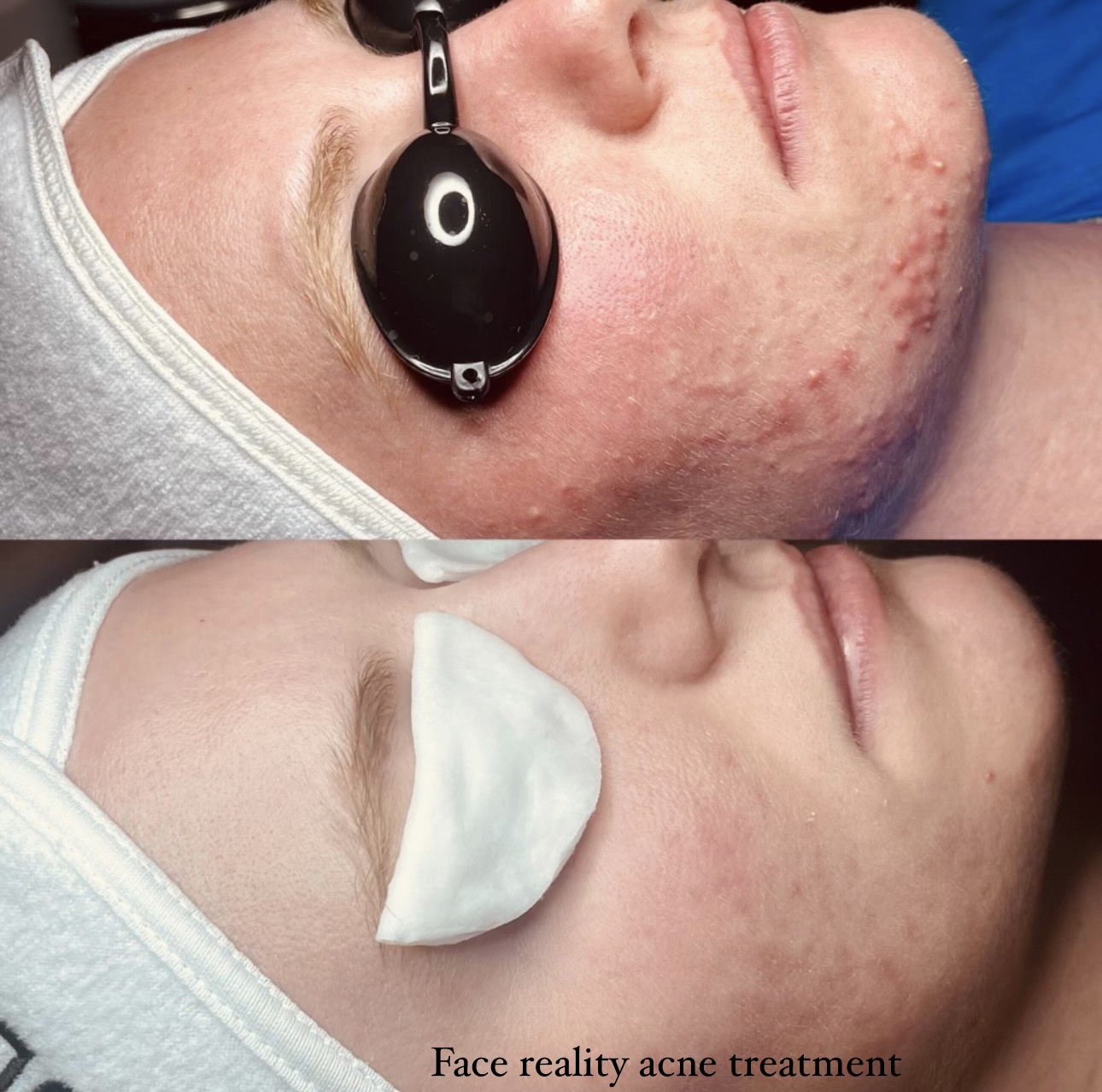 acne Hyperpigmentation results