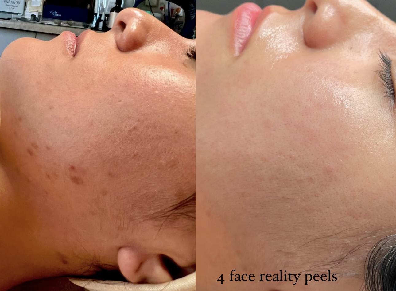 acne facial pics