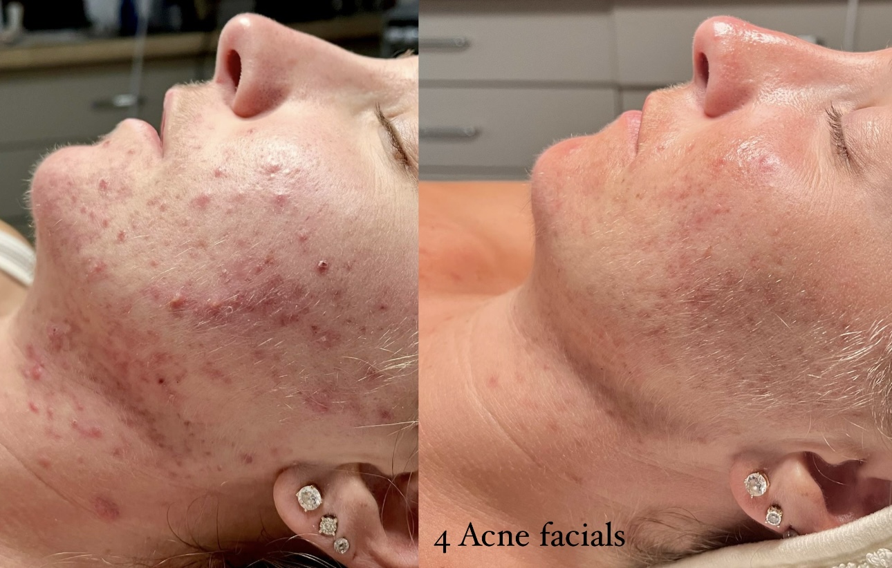after 4 acne facials