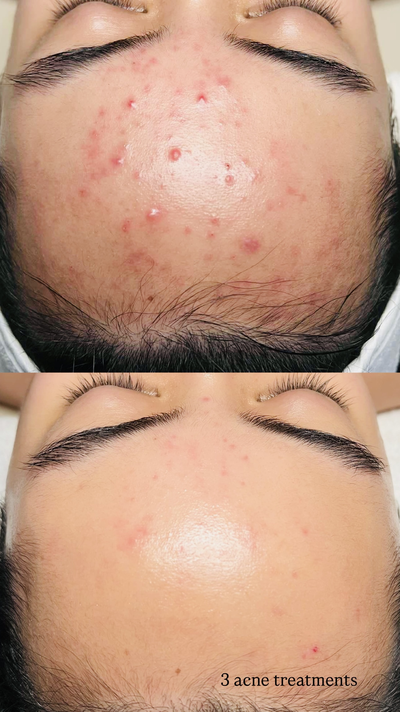 acne after 3 treatments