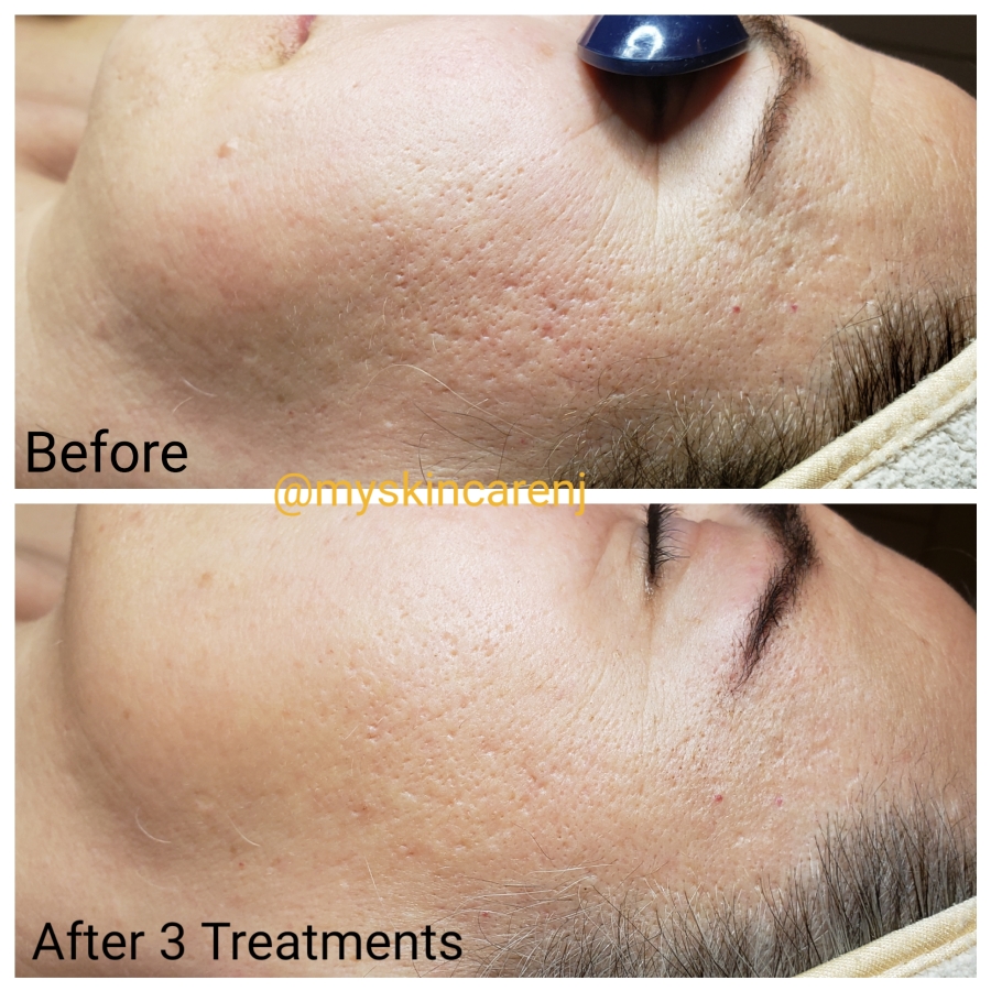 microchanneling, microneedling with procell before and after 3 weeks