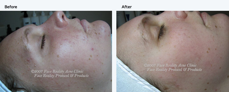 noninflamed_acne