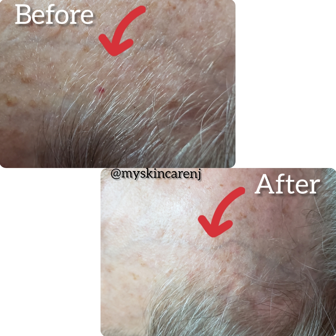 skin tag angiomas before & after