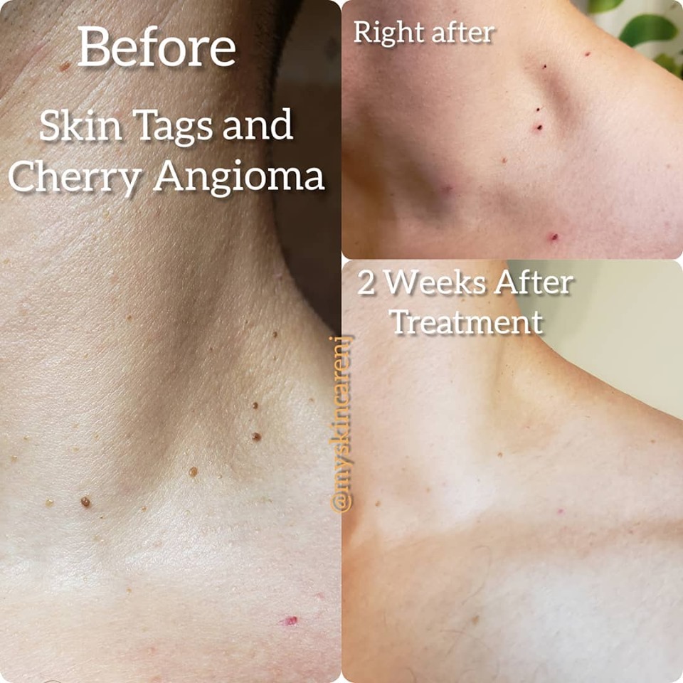 cherry angiomas before & after