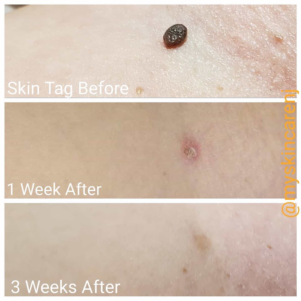 cherry angiomas removed after 3 weeks