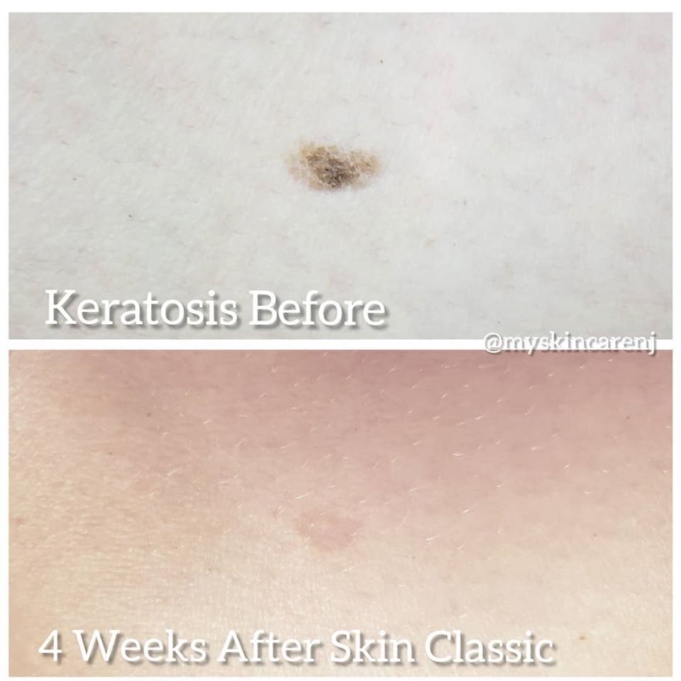 keratosis removed