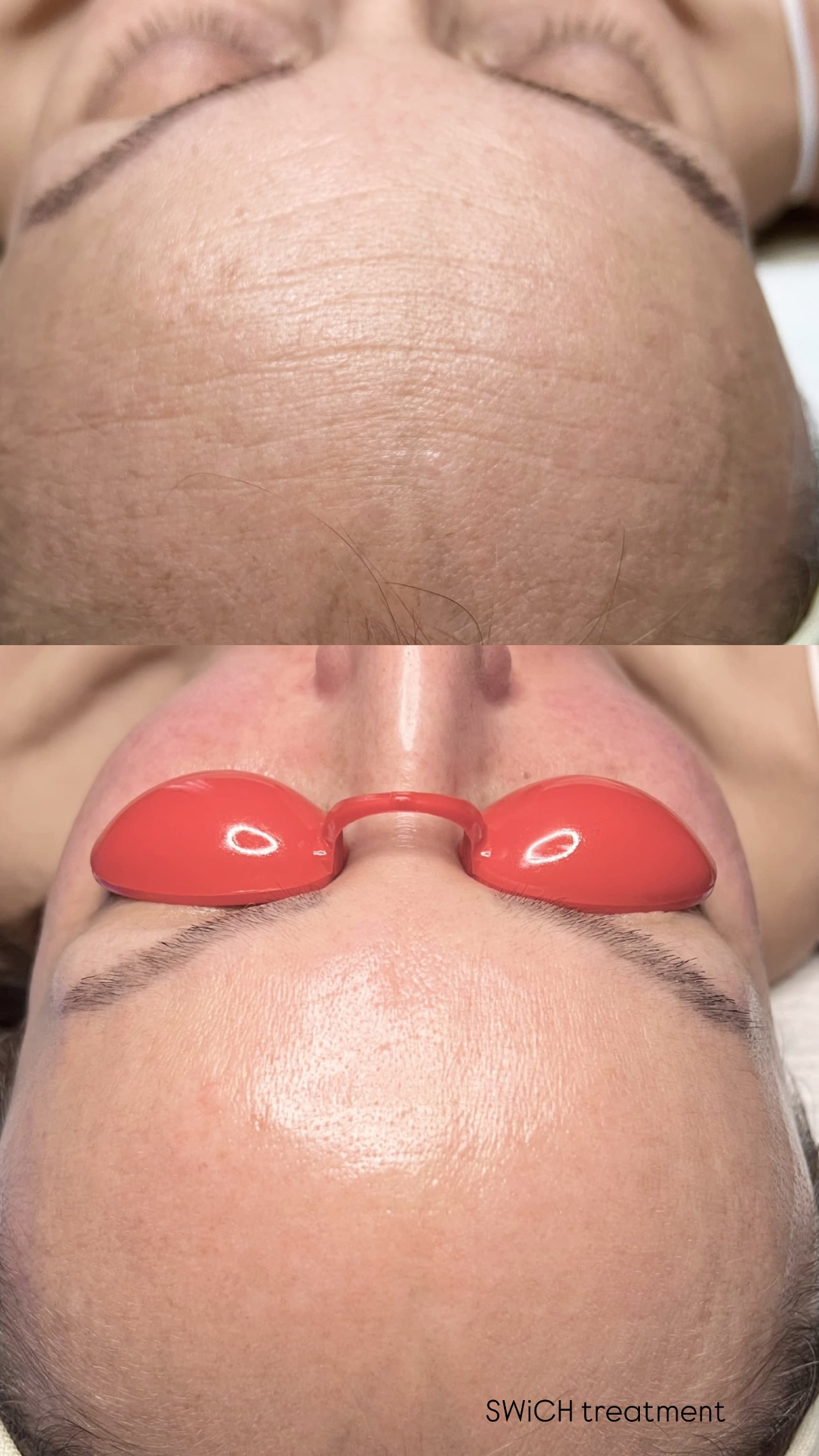 Swich Peel treatment results