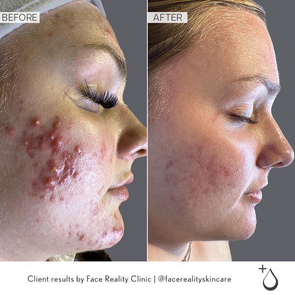 acne treatment results