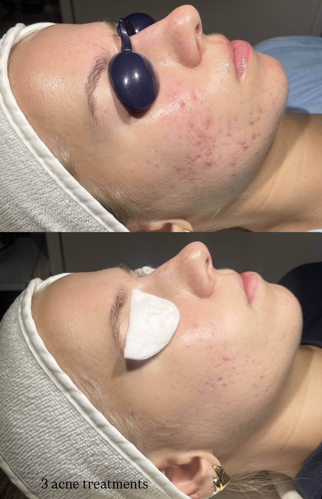 acne after 3 treatments