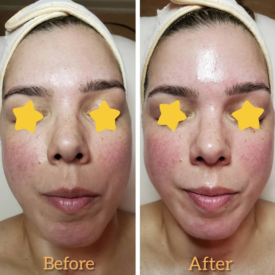 Gua Sha Anti-aging Facial  before & after