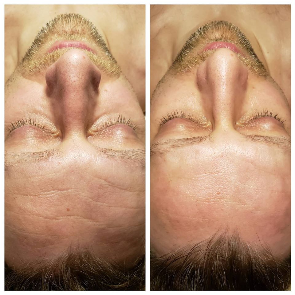 Gua Sha Anti-aging Facial  before & after