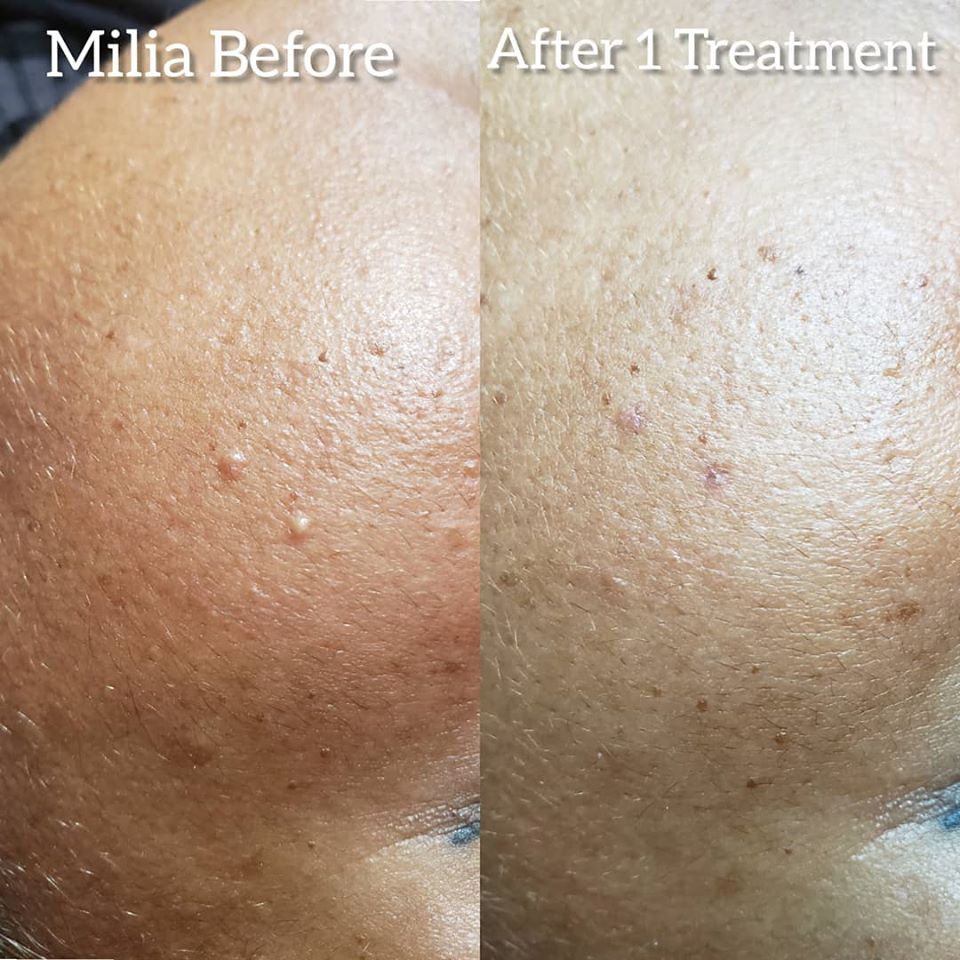 skin tag milia pics before & after